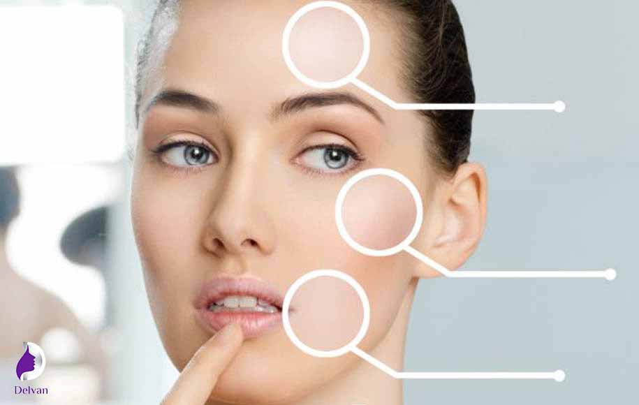 رایج‌ترین عوارض تزریق ژل صورت