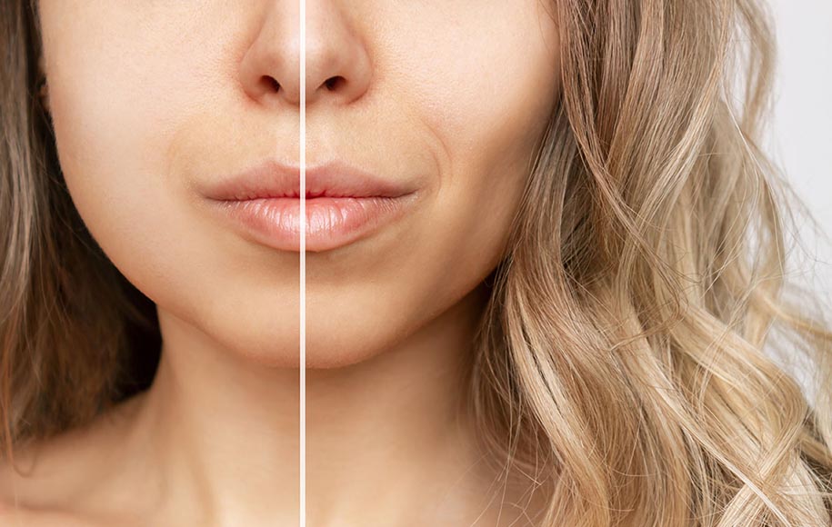 مراقبت های بعد از بوکال فت