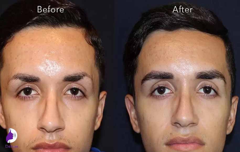 مراقبت پس از کاشت ابرو چیست؟