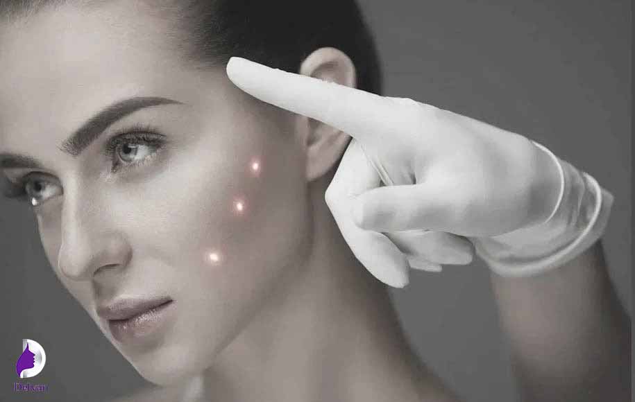مزایای مزوتراپی ابرو چیست؟