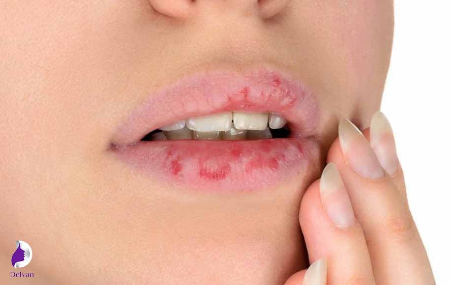 التهاب و عفونت یا واکنش آلرژیک به محصول پرکننده