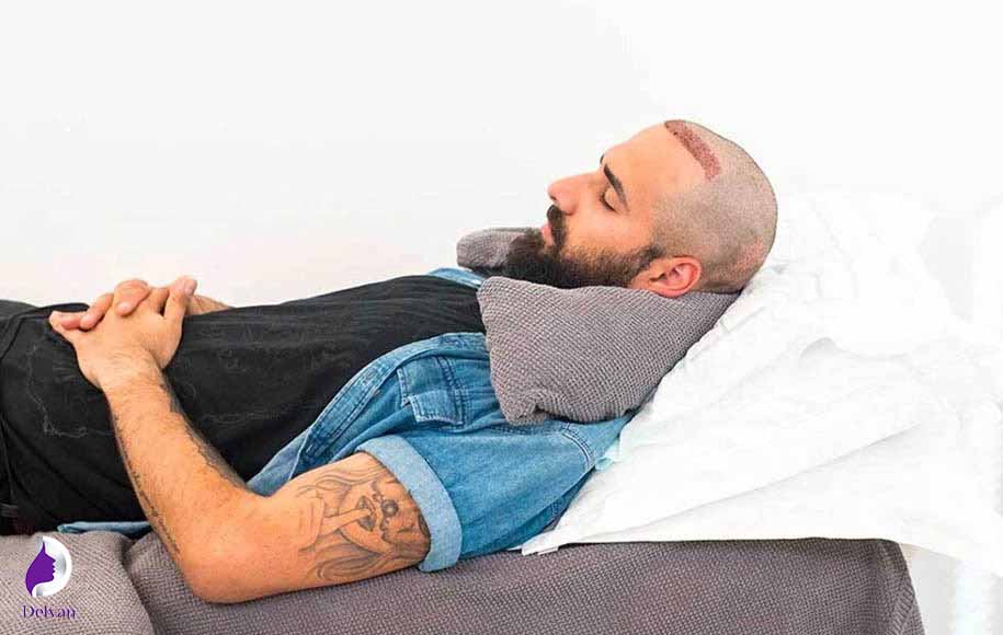 بعد از کاشت مو باید چگونه خوابید؟
