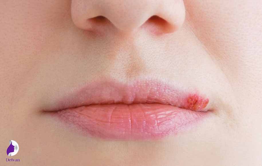 تبخال چیست و چرا بعد از تزریق ژل رخ می‌دهد؟