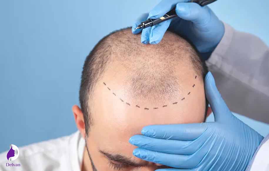 دردهای مرتبط با فرآیند استخراج واحد فولیکولی(FUE)