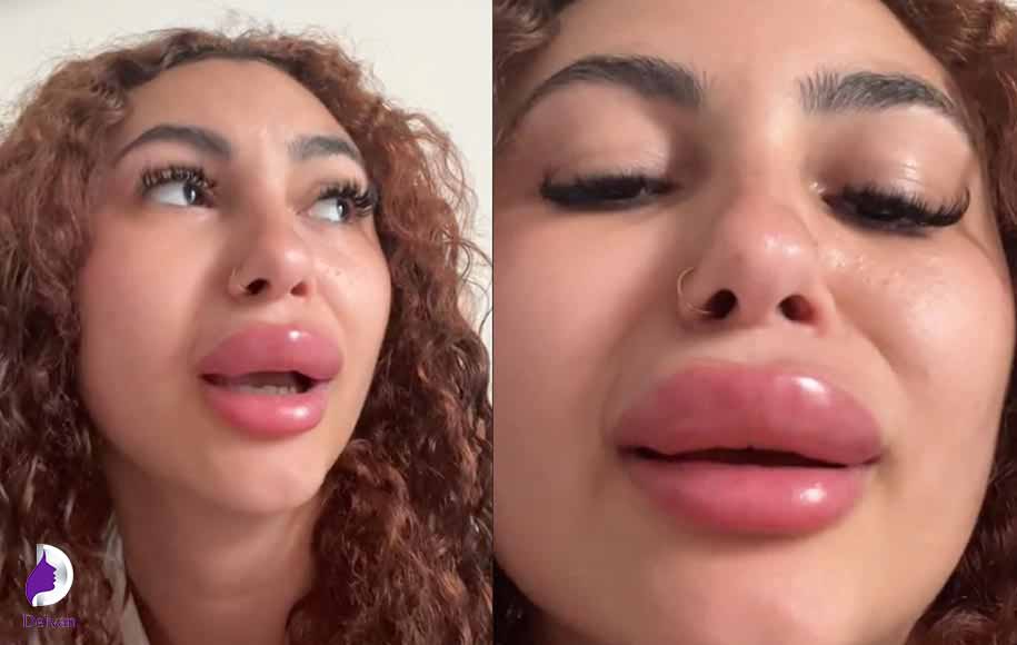 علت ورم لب بعد از تزریق ژل