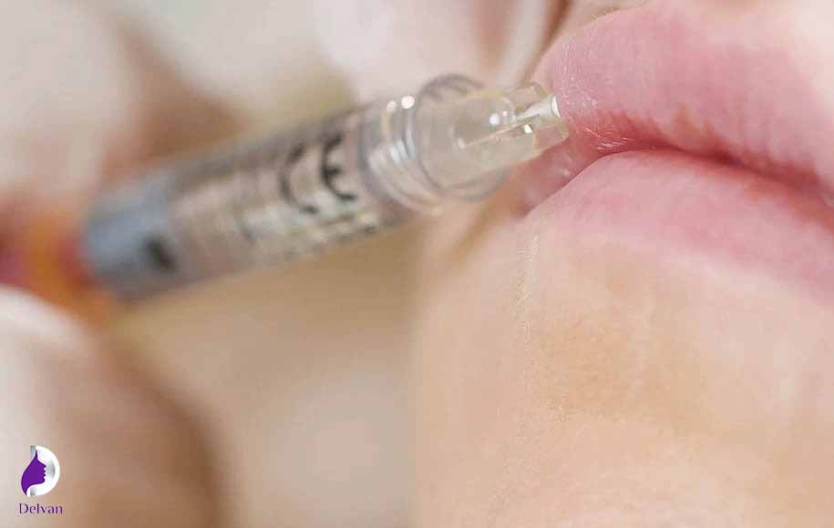 راه‌های جلوگیری از گلوله شدن لب پس از تزریق ژل
