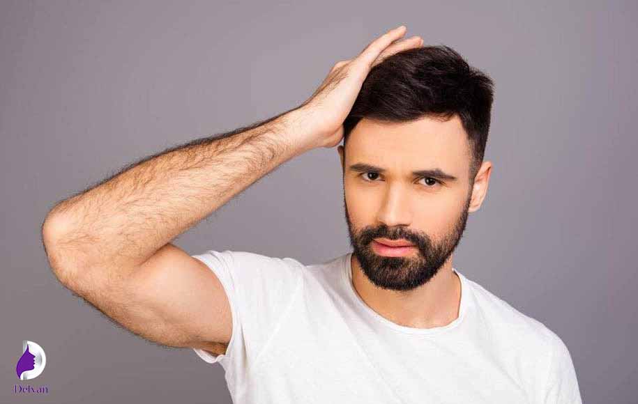 ریزش موهای کاشته شده