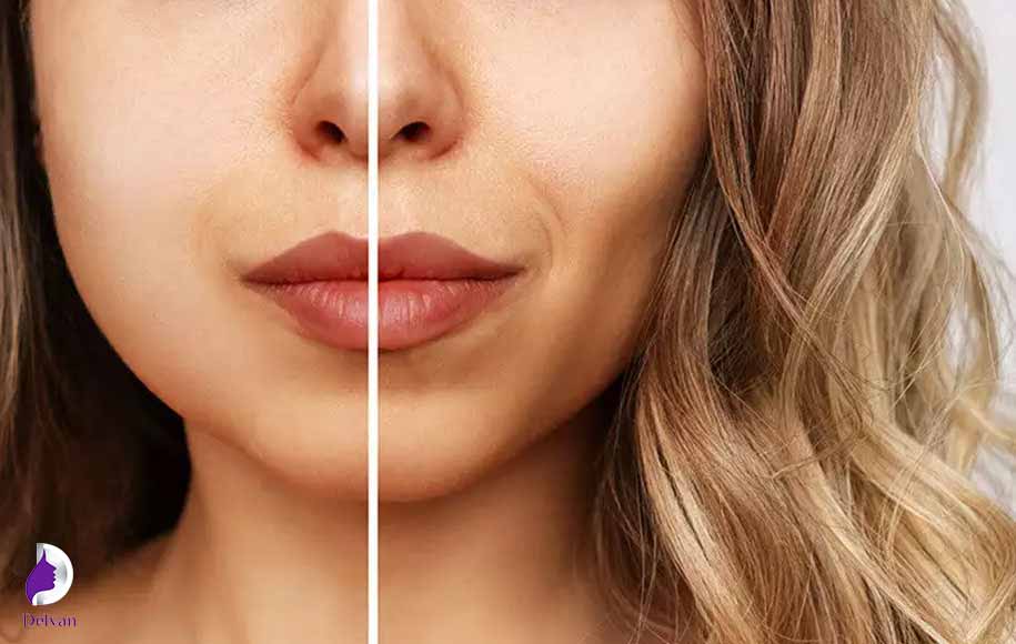 مزایای ماساژ صورت بعد از بوکال فت چیست؟