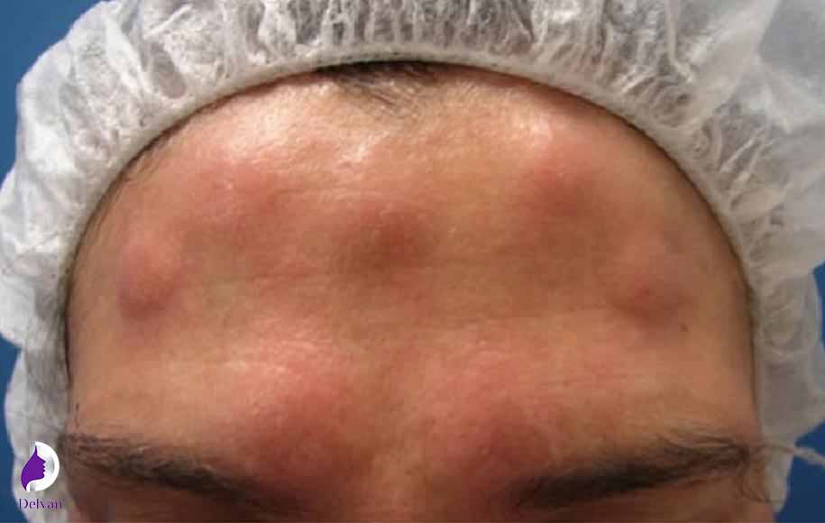 مهم‌ترین علائم آلرژی به بوتاکس