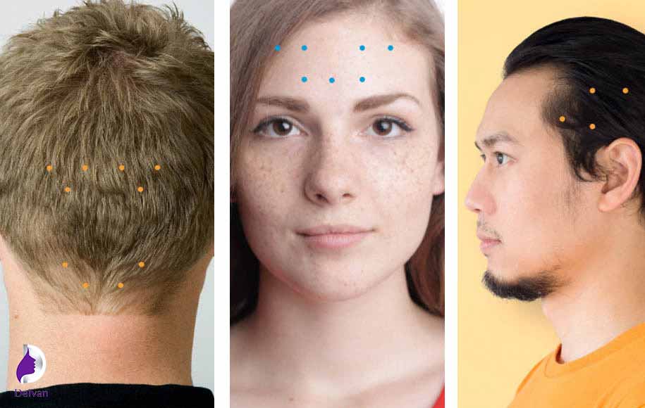 کاربرد بوتاکس میگرن دقیقاً به چه شکل است؟
