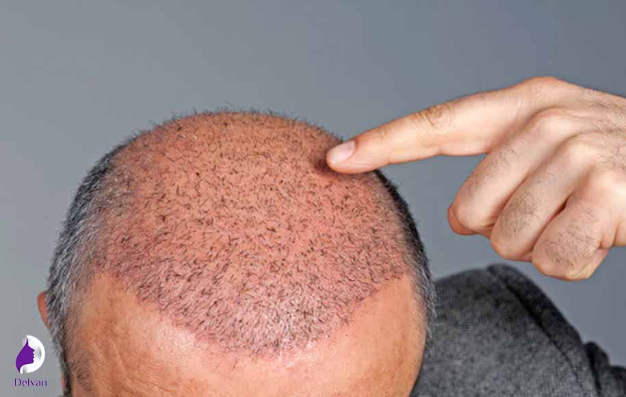 کاشت مو چیست؟